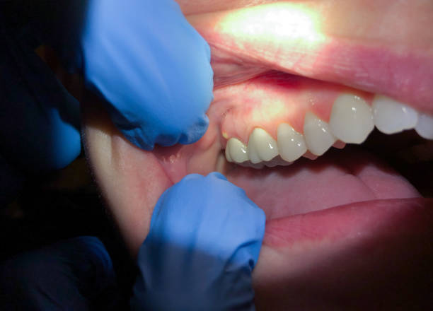 Best Tooth Infection Emergency Dentist  in Gunter, TX